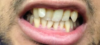 Before cosmetic Treatment Reading Smiles Before cosmetic Treatment Reading Smiles
