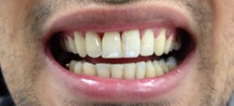 After cosmetic Treatment Reading Smiles After cosmetic Treatment Reading Smiles