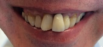 Before veneers Treatment Reading Smiles Before veneers Treatment Reading Smiles