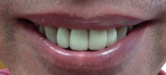After Veneers Treatment Reading Smiles After Veneers Treatment Reading Smiles