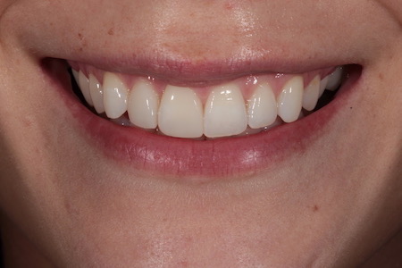 After Invisalign Treatment Reading Smiles After Invisalign Treatment Reading Smiles