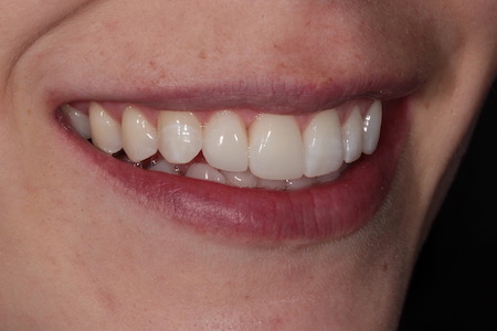 After Invisalign Treatment Reading Smiles After Invisalign Treatment Reading Smiles