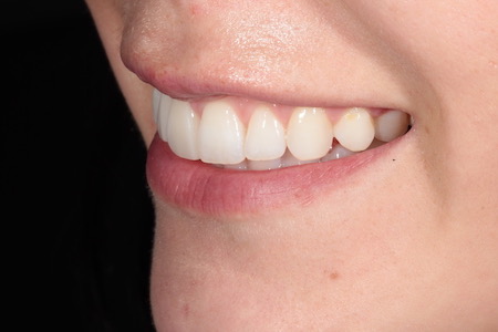After Invisalign Treatment Reading Smiles After Invisalign Treatment Reading Smiles