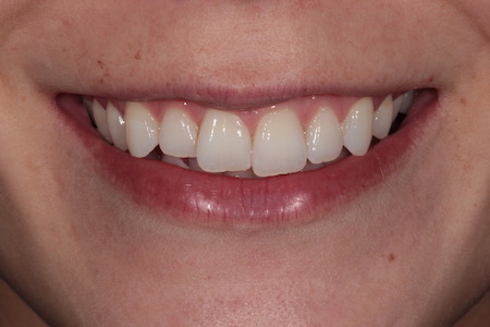 Before Invisalign Treatment Reading Smiles Before Invisalign Treatment Reading Smiles