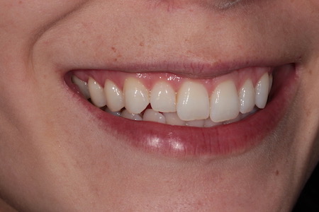 Before Invisalign Treatment Reading Smiles Before Invisalign Treatment Reading Smiles