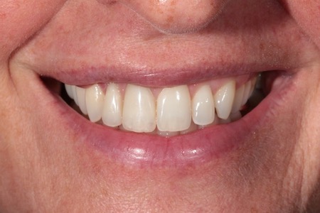 After Veneers Treatment Reading Smiles After Veneers Treatment Reading Smiles