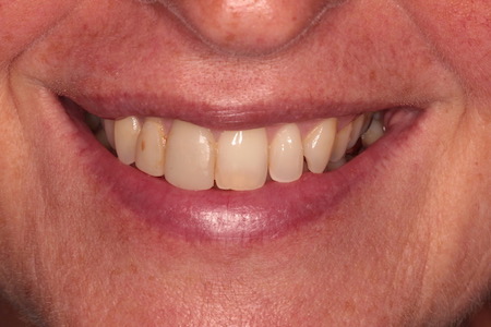 Before veneers Treatment Reading Smiles Before veneers Treatment Reading Smiles