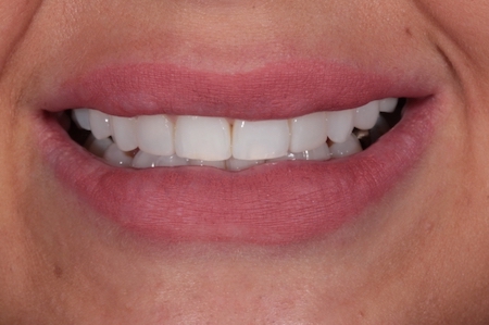 After Invisalign Treatment Reading Smiles After Invisalign Treatment Reading Smiles