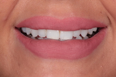 Before Invisalign Treatment Reading Smiles Before Invisalign Treatment Reading Smiles