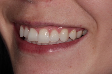 Before Invisalign Treatment Reading Smiles Before Invisalign Treatment Reading Smiles