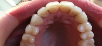 After cosmetic Treatment Reading Smiles After cosmetic Treatment Reading Smiles