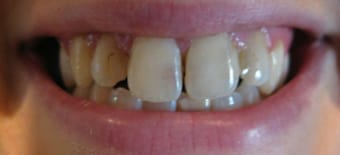Before veneers Treatment Reading Smiles Before veneers Treatment Reading Smiles