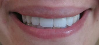 After Veneers Treatment Reading Smiles After Veneers Treatment Reading Smiles