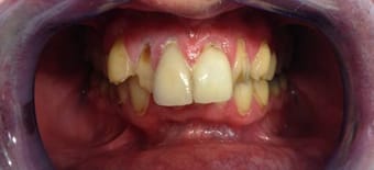Before Smile Makeover Treatment Reading Smiles Before Smile Makeover Treatment Reading Smiles