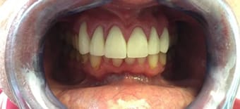 After Smile Makeover Treatment Reading Smiles After Smile Makeover Treatment Reading Smiles