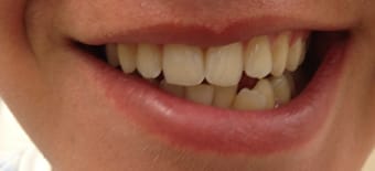 Before Smile Makeover Treatment Reading Smiles Before Smile Makeover Treatment Reading Smiles