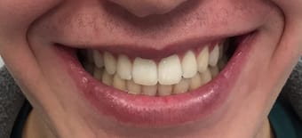 After Smile Makeover Treatment Reading Smiles After Smile Makeover Treatment Reading Smiles