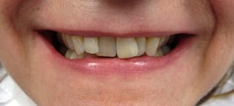 Before Smile Makeover Treatment Reading Smiles Before Smile Makeover Treatment Reading Smiles