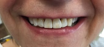 After Smile Makeover Treatment Reading Smiles After Smile Makeover Treatment Reading Smiles