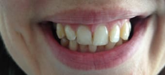 Before Smile Makeover Treatment Reading Smiles Before Smile Makeover Treatment Reading Smiles