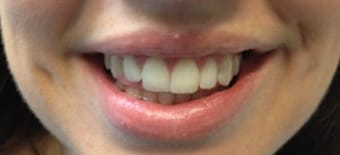 After Smile Makeover Treatment Reading Smiles After Smile Makeover Treatment Reading Smiles
