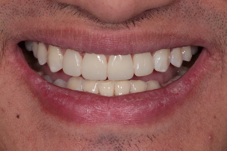 After Veneers Treatment Reading Smiles After Veneers Treatment Reading Smiles