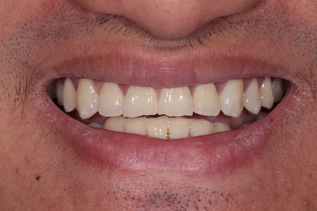 Before veneers Treatment Reading Smiles Before veneers Treatment Reading Smiles