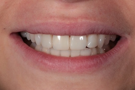 After Veneers Treatment Reading Smiles After Veneers Treatment Reading Smiles