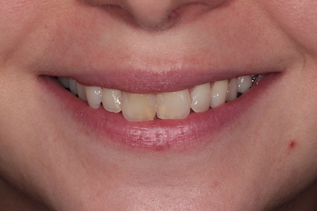 Before veneers Treatment Reading Smiles Before veneers Treatment Reading Smiles