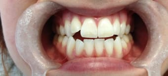 Before cosmetic Treatment Reading Smiles Before cosmetic Treatment Reading Smiles