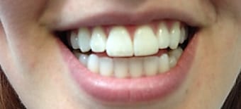 After cosmetic Treatment Reading Smiles After cosmetic Treatment Reading Smiles