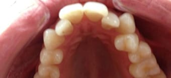 Before cosmetic Treatment Reading Smiles Before cosmetic Treatment Reading Smiles
