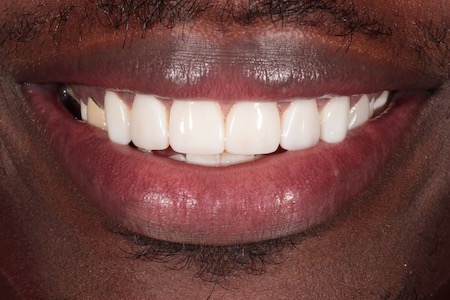 After Veneers Treatment Reading Smiles After Veneers Treatment Reading Smiles