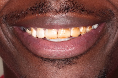 Before veneers Treatment Reading Smiles Before veneers Treatment Reading Smiles
