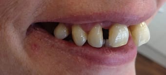 Before veneers Treatment Reading Smiles Before veneers Treatment Reading Smiles