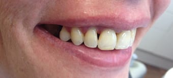 After Veneers Treatment Reading Smiles After Veneers Treatment Reading Smiles