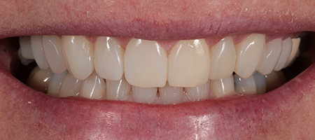 Bonding-1-a After Invisalign Treatment Reading Smiles