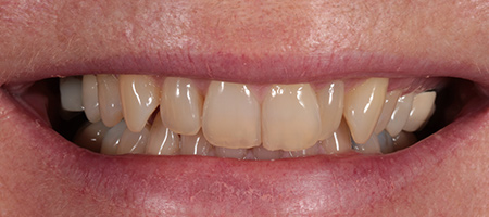 Bonding-1-b Before & after cosmetic bonding