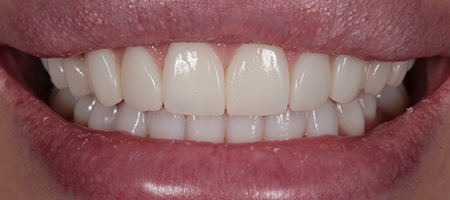 Bonding-a-10 After Invisalign Treatment Reading Smiles