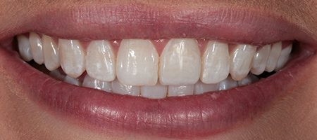 Bonding-a-2 After Invisalign Treatment Reading Smiles