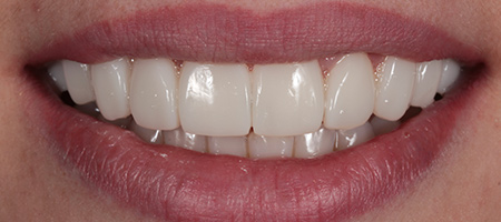 Bonding-a-3 After Invisalign Treatment Reading Smiles