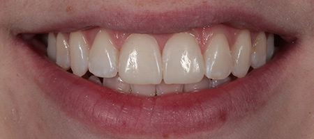 Bonding-a-4 After Invisalign Treatment Reading Smiles