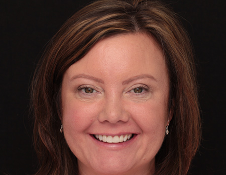 Bonding-a-5-1 After Invisalign Treatment Reading Smiles