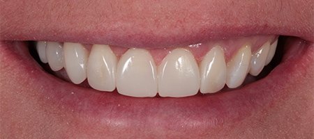 Bonding-a-5 After Invisalign Treatment Reading Smiles