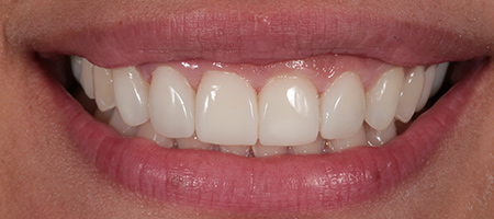 Bonding-a-6 After Invisalign Treatment Reading Smiles