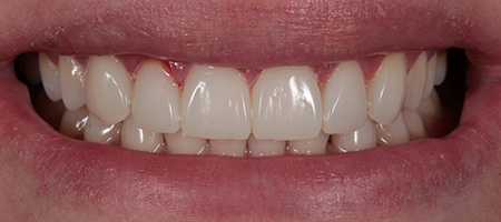 Bonding-a-7 After Invisalign Treatment Reading Smiles
