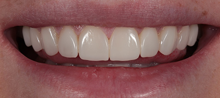 Bonding-a-8 After Invisalign Treatment Reading Smiles