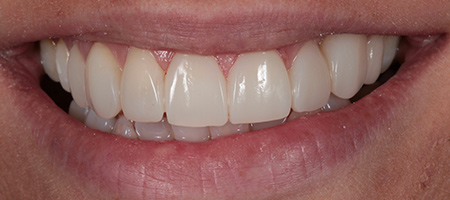 Bonding-a-9 After Invisalign Treatment Reading Smiles