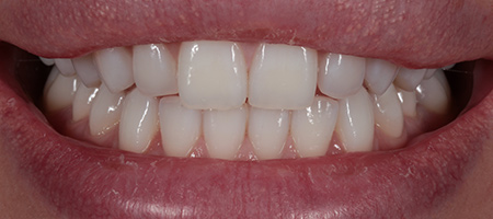 Bonding-b-10 Before & after cosmetic bonding