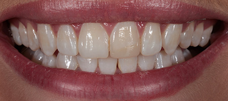 Bonding-b-2 Before & after cosmetic bonding